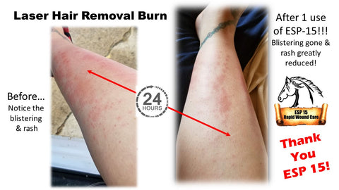 ESP-15 helped relieve the effects of this woman's laser hair removal burn.