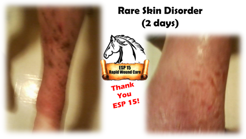 ESP-15 vs Rare Skin Disorder