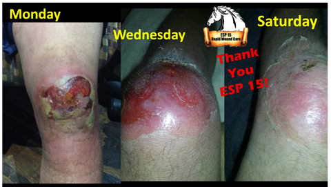 ESP-15 vs Unknown Infection 5 days!