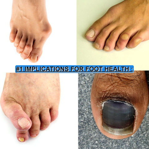 A collage of images depicting bunions, hammertoes, corns and calluses, highlighting the foot-related problems that can result from wearing narrow shoes.