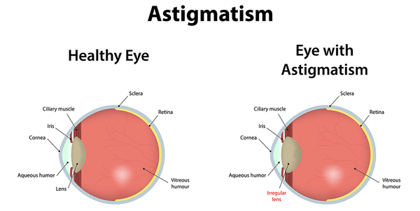 The difference between astigmatism