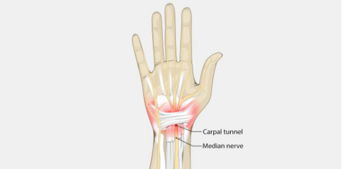 understand what is carpal tunnel syndrome and how can it affect your hand