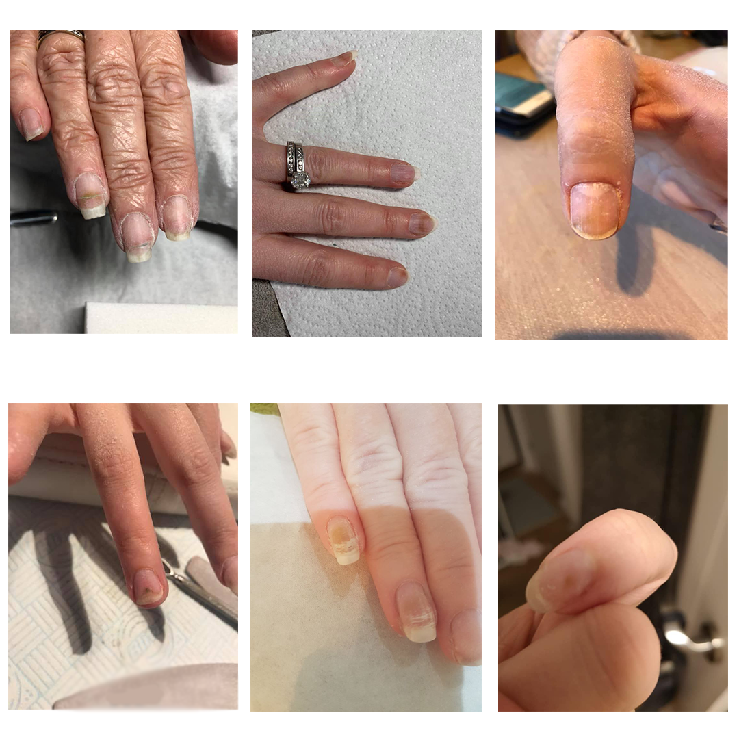 What you need to know about pseudomonas nail infections aka 