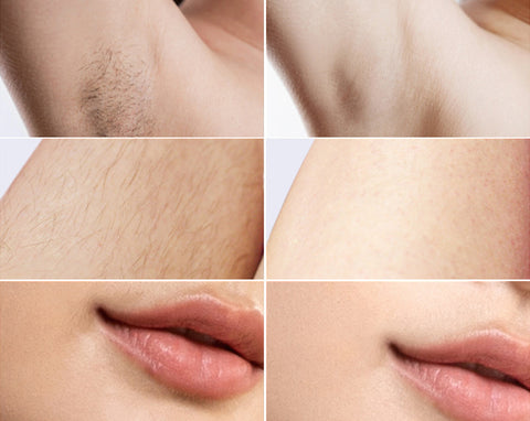 the best effective hair removal hanset before-after
