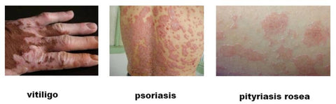 Best Treatment For Skin Disorder - Psoriasis Vitiligo and Eczema