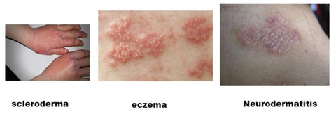 uv treatment for psoriasis Vitiligo Eczema