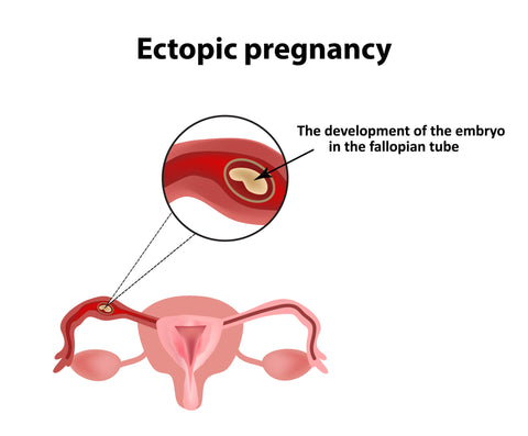 ectopic pregnancy diagram
