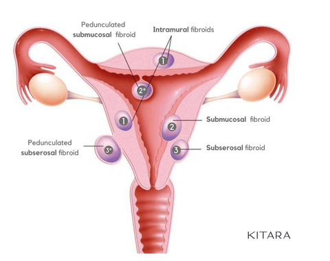 Types of fibroids. Yoni Steaming for Fibroids.