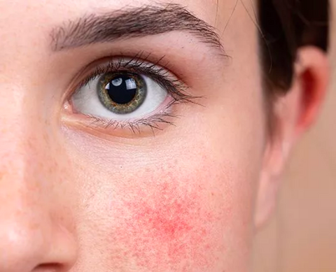 mujer con rosacea en la piel