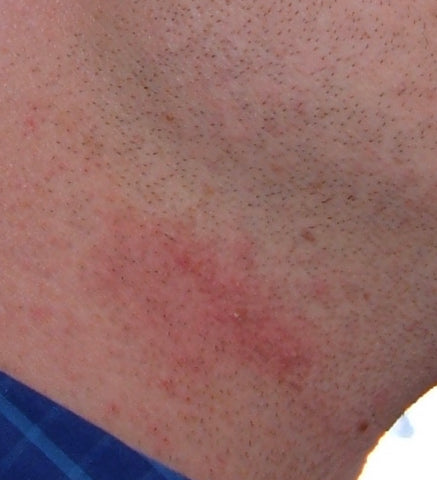 Razor burn caused by shaving