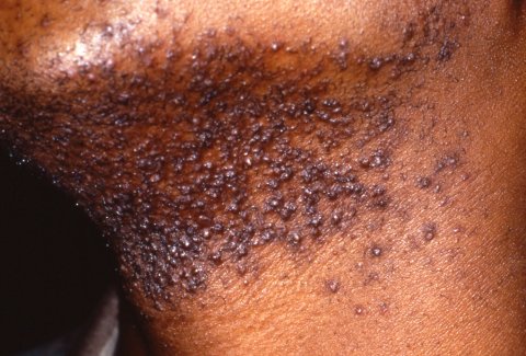 Pseudofolliculitis barbae photo caused by shaving