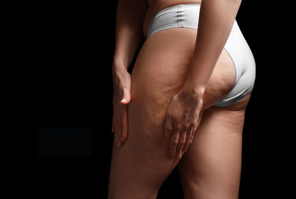 what is cellulite