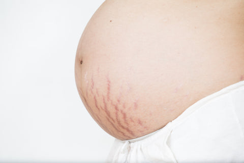 cellulite pregnancy