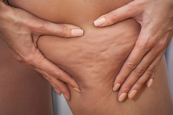CAUSES OF CELLULITE