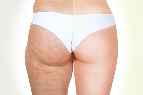 anti cellulite cream