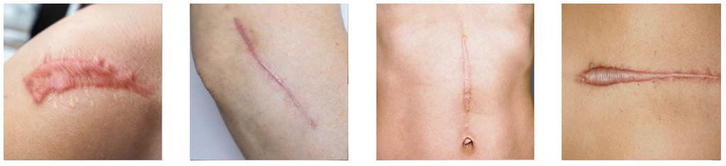 Scars that are more silver, brown, pink, red or purple-like.