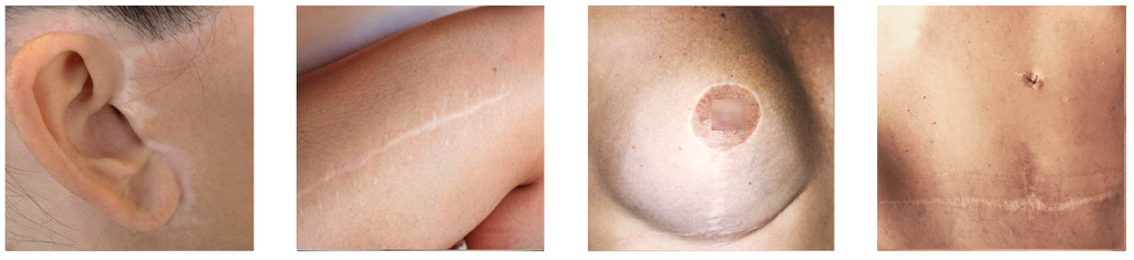 Different white-colored scars shown on the human body.