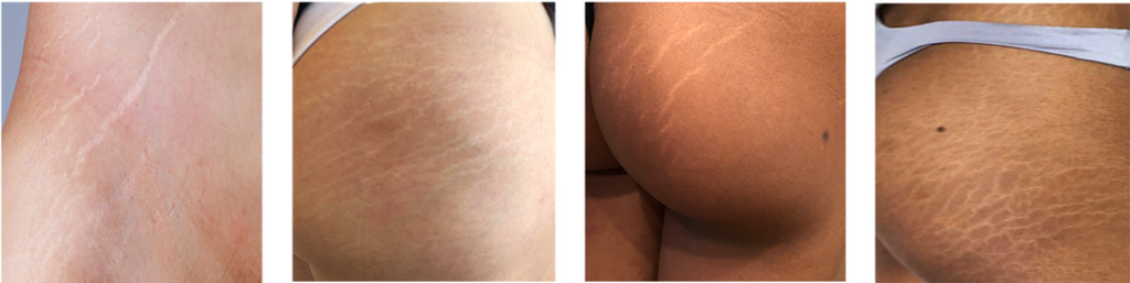 White-looking stretch marks