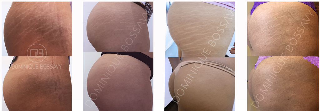 Nano Color Infusion before and after picture: stretch marks