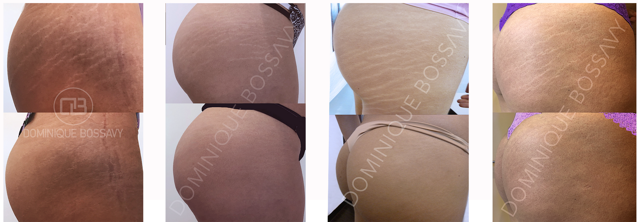 As a permanent makeup artist should I tattoo stretch marks  Ink Illusions