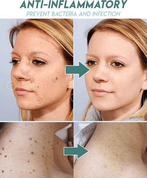 Skin tag removal treatment patch uses dermatologist tested salicylic formulation to remove skin tags safely. The patch works by shrinking and drying the skin tags until they fall off naturally.
