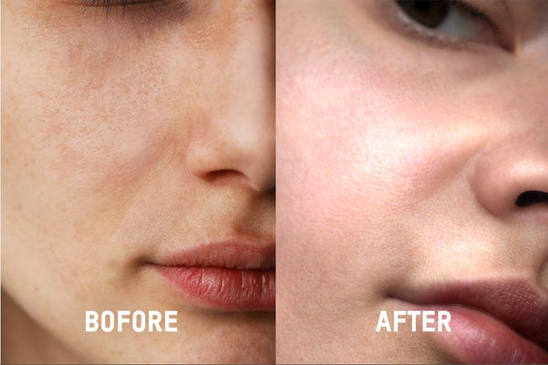 hyaulronic acid serum before and after