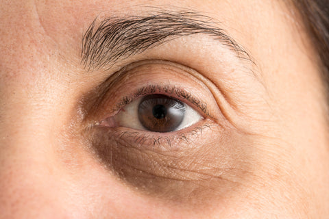 how to get rid of eye dark circles?