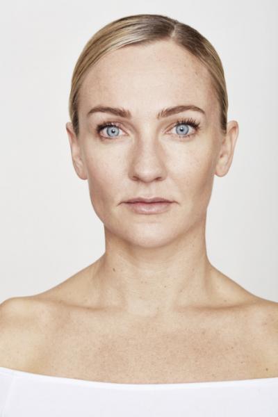 Face of lady after dermal filler treatment