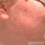 Acne after laser treatment