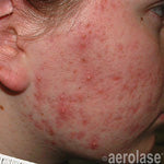 Acne before laser treatment