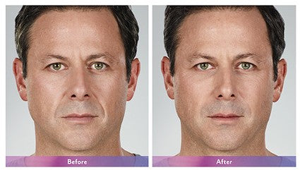 Before and after image of dermal filler for men