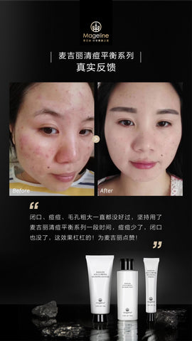 mageline skincare for acne, pimple, congested skin