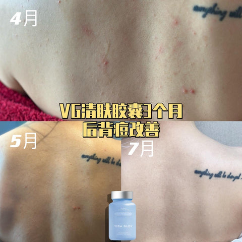 Vida Glow Clear, Back Acne, Sensitive skin supplement, oily skin