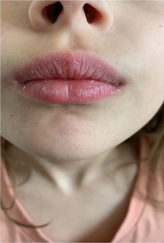 Dry Lips before treatment