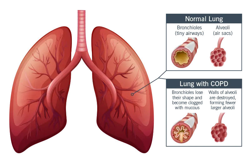 Help With Asthma And Copd Symptoms By Breath Training Airofit