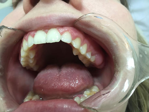 closeup of patient's opened mouth at the dentist