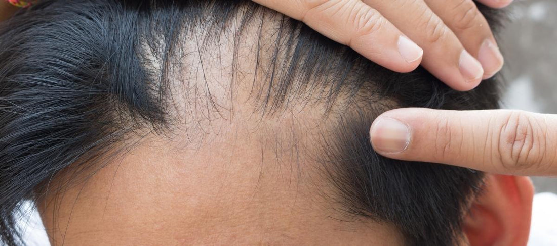 PURA DOR Hair Loss Prevention Therapy Energizing Scalp Serum 4 Fluid  Ounce  Amazonin Beauty