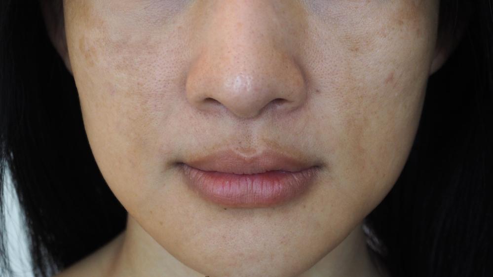 why-do-i-have-dark-spots-on-my-skin-eden-beauty