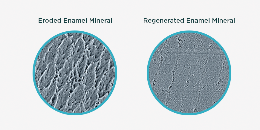 erosione dentale regenerate prima e dopo