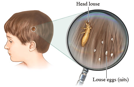 Head Louse and Eggs