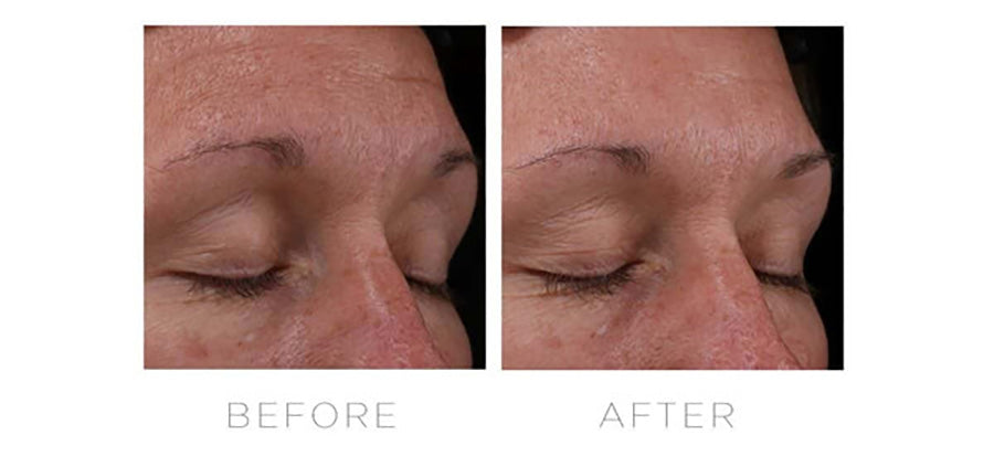 CosMedix Serum 16 Retinol Complex before and after