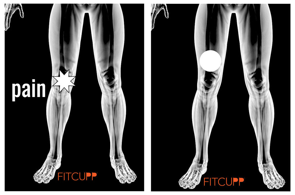 Knee Pain and Placement for FITCUPP® | Low Effort FITCUPPING FITCUPP® Self Fit Inc. Contemporary Cupping