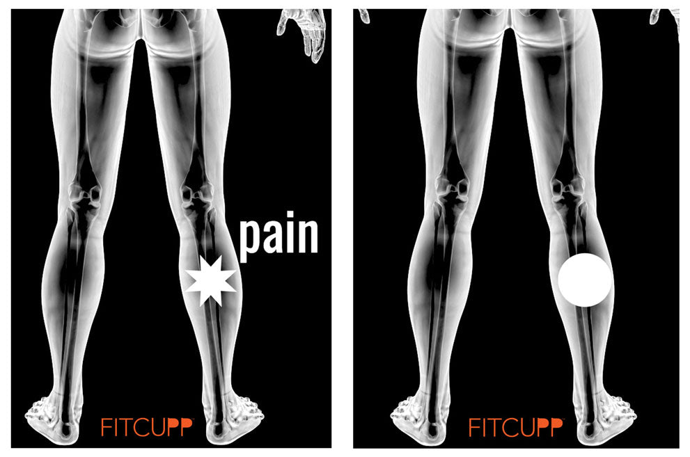 Back of Knee Pain and Placement for FITCUPP® | Low Effort FITCUPPING FITCUPP® Self Fit Inc. Contemporary Cupping