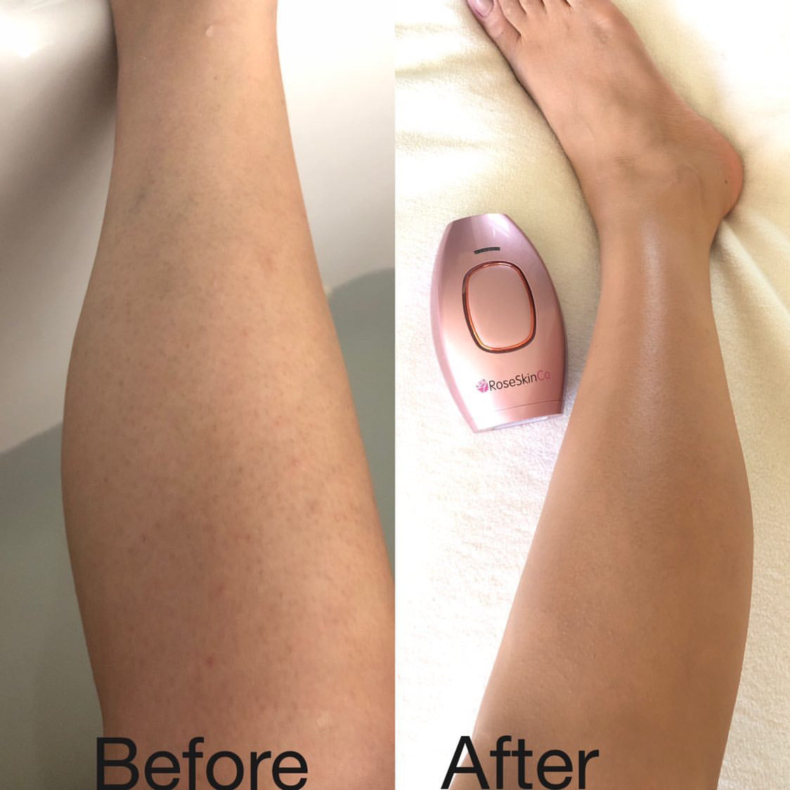 ipl vs laser hair removal