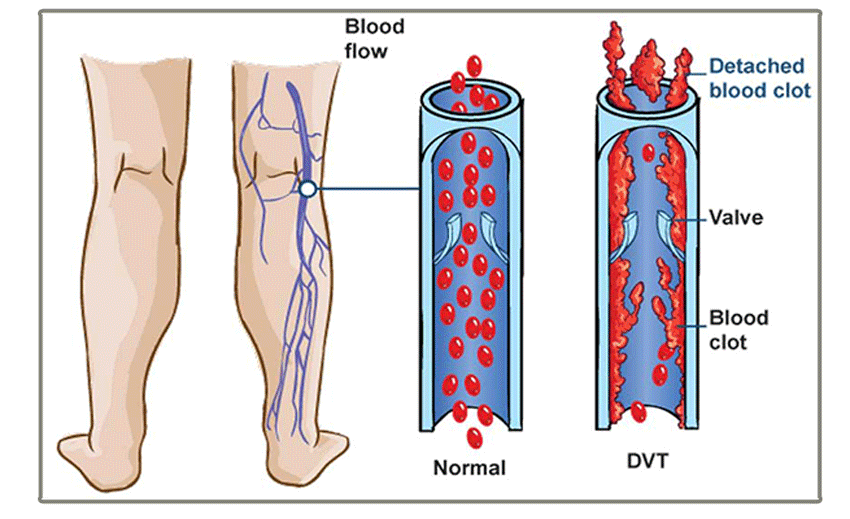 DVT - Deep Vein Thrombosis - Prevention – Dr. Segal's - Canada