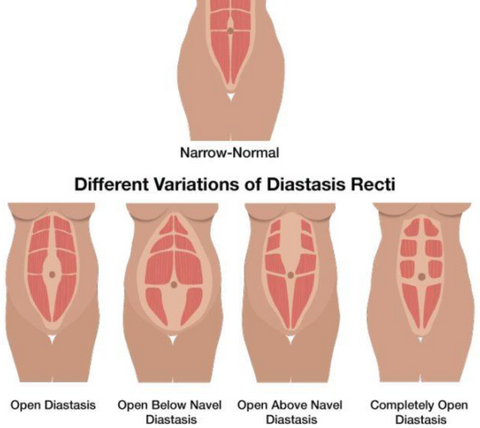 Five Exercises to Heal Diastasis Recti (DR) – Sweat and Milk LLC