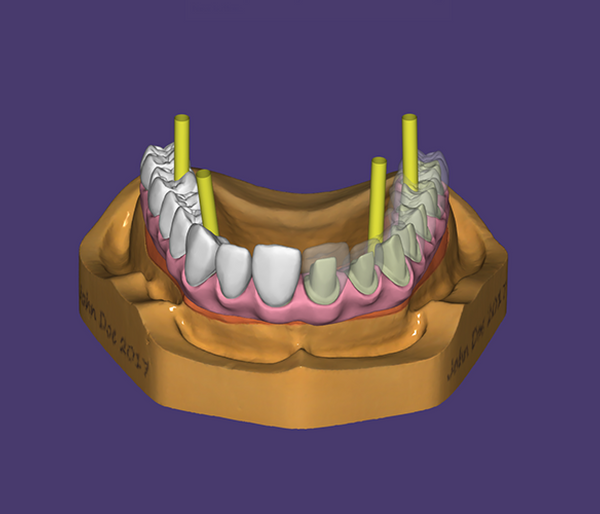 Custom ThermoPlas Full Arch Denture: Flexible Comfort at $349 – Rosenthal  Dental Laboratory