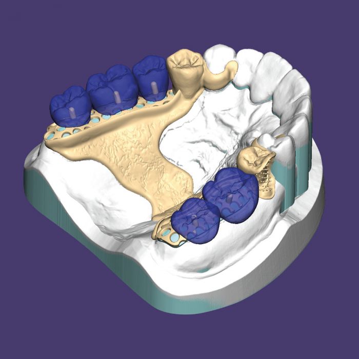 Custom ThermoPlas Full Arch Denture: Flexible Comfort at $349 – Rosenthal  Dental Laboratory