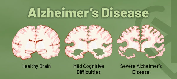 An image depicting how Alzheimer's affects the brain