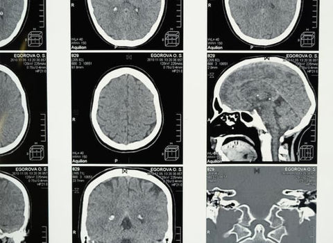 improved-cognition-with-earthing-grounding-conners-clinic